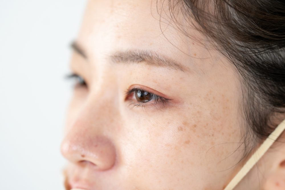 しみがある女性